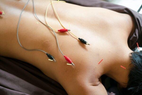 Electro-Acupuncture