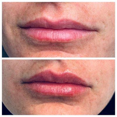 Lip enhancement with Jeuvderm Ultra