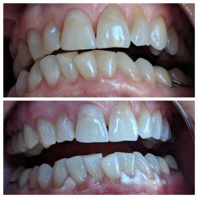 Very nice whitening result.