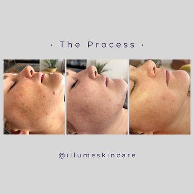 Skin improvement with Illume skincare