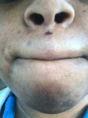 The wax burn on my upper lip.