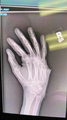 X-ray Finger cracked