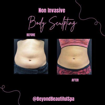 Body Sculpting before and after