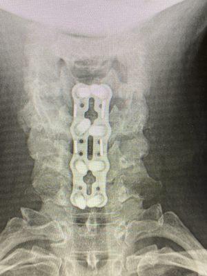 Front view cervical fusion