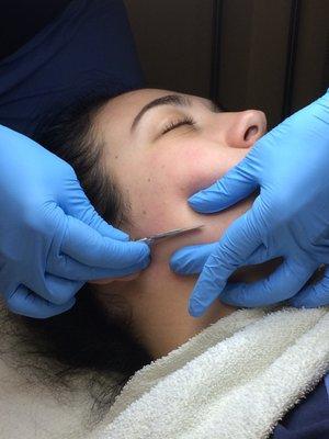 DermaPlaning is the use of a sterilized scapel to remove vellus hair from the face and neck. Leaves the skin brighter, and  smoother.