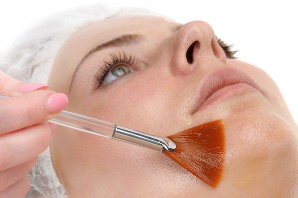 Chemical Peel