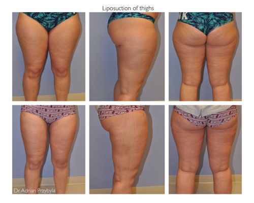 Before & after - Liposuction of thighs Performed by Dr. Adrian Przybyla