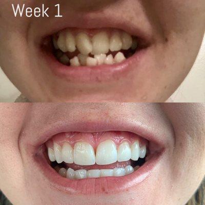 Before and After with 1 year of Invisalign!