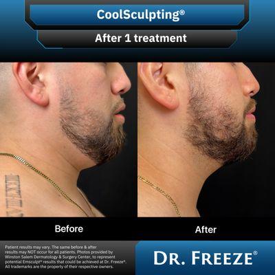 1 CoolSculpting® treatment on chin area