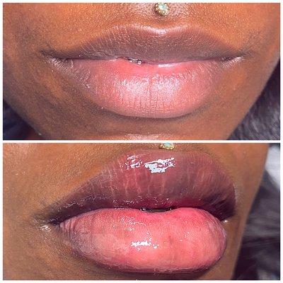 Hyaluronic Lip Filler