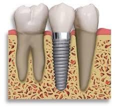 Dental Implant brings you the confidence in life for the missing teeth