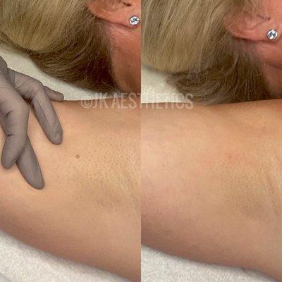 Skin Tag removal