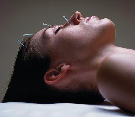 Facial Acupuncture