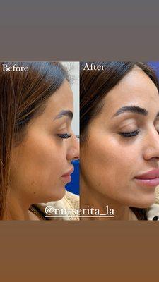 Jaw line filler for face contouring and definition