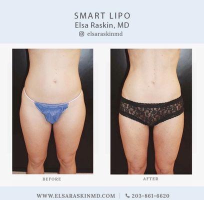 Liposuction abdomen and thighs