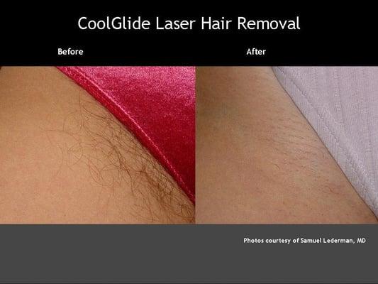 Laser Hair Removal- Bikini