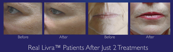 Our Micro-needling with pro-cells will give you fast results.