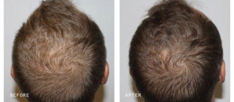 Series of 3 Keravive scalp treatments