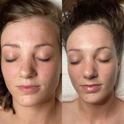 Microdermabrasion/Hydration Facial