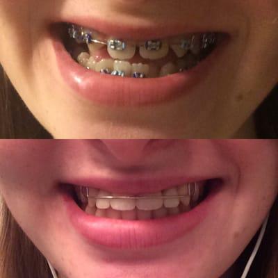 My underbite, crooked teeth, and overall mess of a mouth on the day I got my braces on and then on the day I got them off