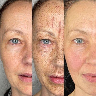 Before, Immediately After and After Healed - Plasma Fibroblast