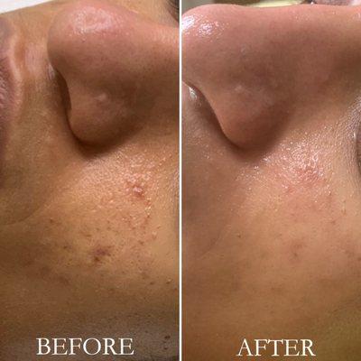 Microneedling