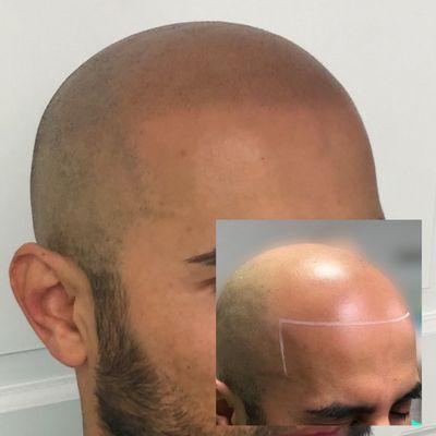 Scalp micropigmentation for hair loss