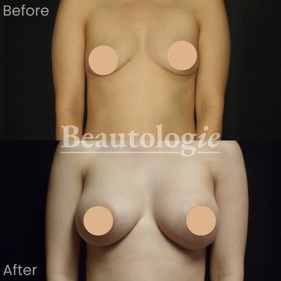 Bilateral Breast Augmentation with 400ml Saline Implants Before and After