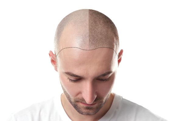 Scalp Micropigmentation Example Front