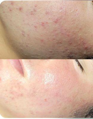 Acne healing before and after