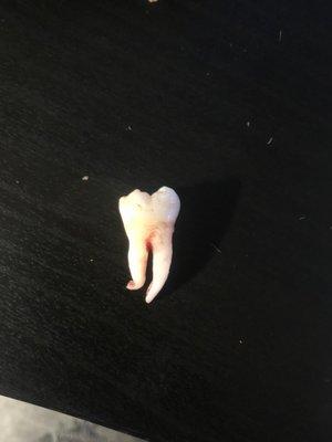 My favorite tooth that they removed