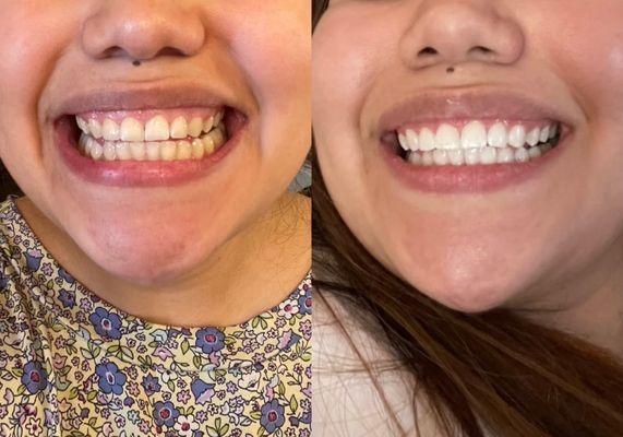 My teeth BEFORE vs. 1 day AFTER getting them professionally whitened.