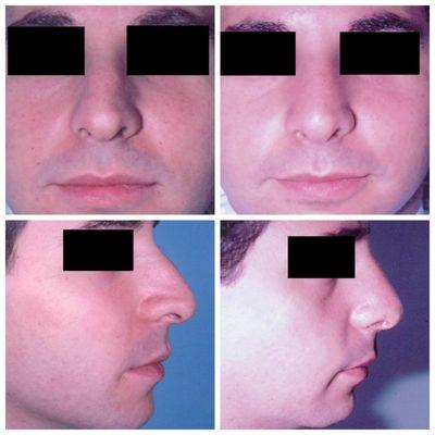 Rhinoplasty