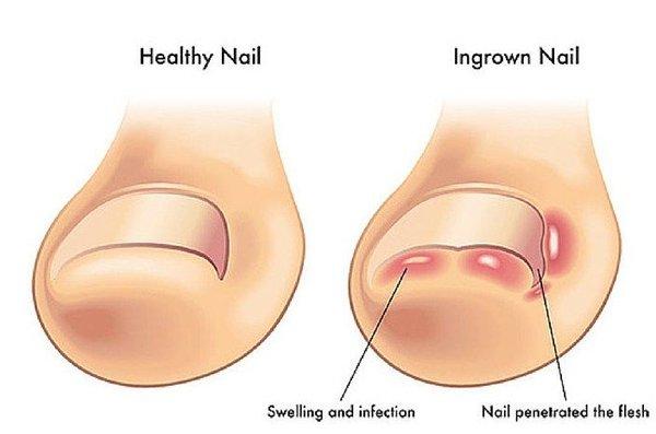 Ingrown Nail Treatment