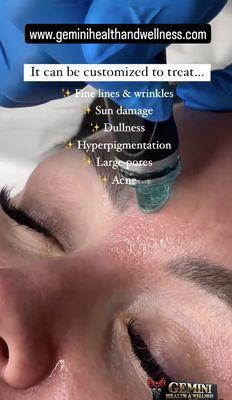 Hydrafacials-- No Downtime!