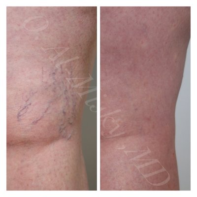 Before /After: Spider veins