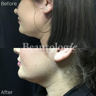 Kybella Before and After