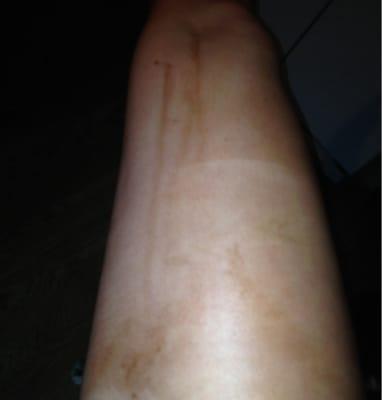 My leg after their spray tan :(