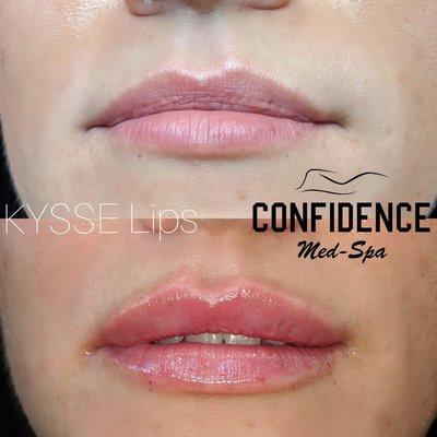 Lip augmentation. Kysse Lips immediately post 1 syringe.