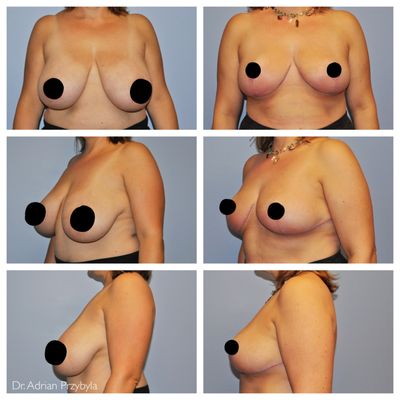 Before & after - Breast reduction - Performed by Dr. Adrian Przybyla