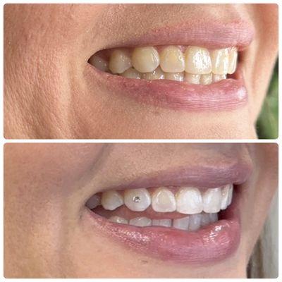 1hr whitening & crystal tooth gem