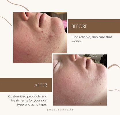 Acne program