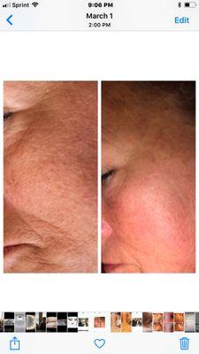 Anti-aging facial Before/after 1 treatment