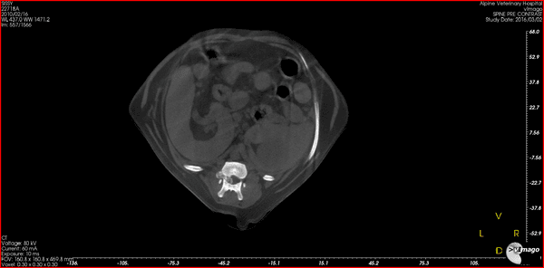 Axial CT slice showing herniated disc