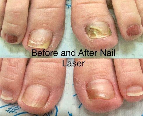 Before and After Nail Laser Treatment