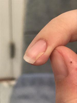 Yellow-ish nail fungus (maybe?) on my pinky