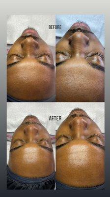 Microdermabrasion