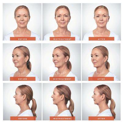 Get Kybella® today to eliminate your double chin!