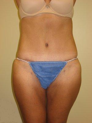 Tummy Tuck- 3 months post-op.