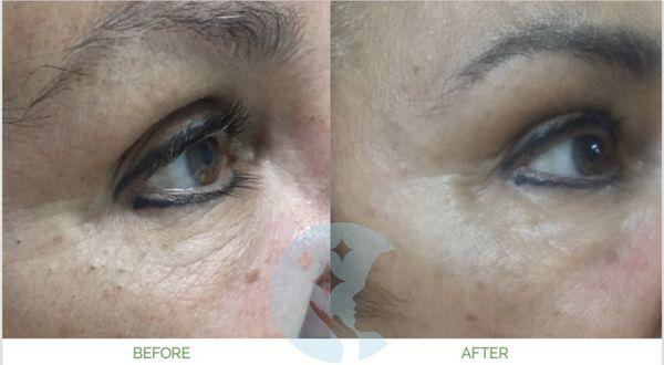 Collagen Induction Therapy - Before and After 8 sessions of personalized treatment.